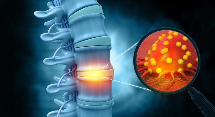 Kanserin 7 türünde birden görünen erken belirtiye dikkat!