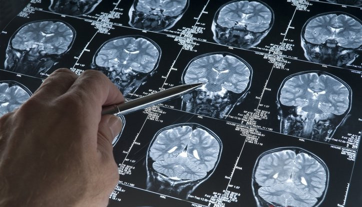 Alzheimer 20 yıl önce bu belirtiyle sinyal veriyor: Bu besin riski sıfırlıyor!